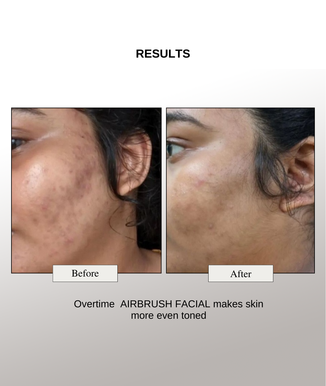 The Formularx air brush facial lactic acid serum results