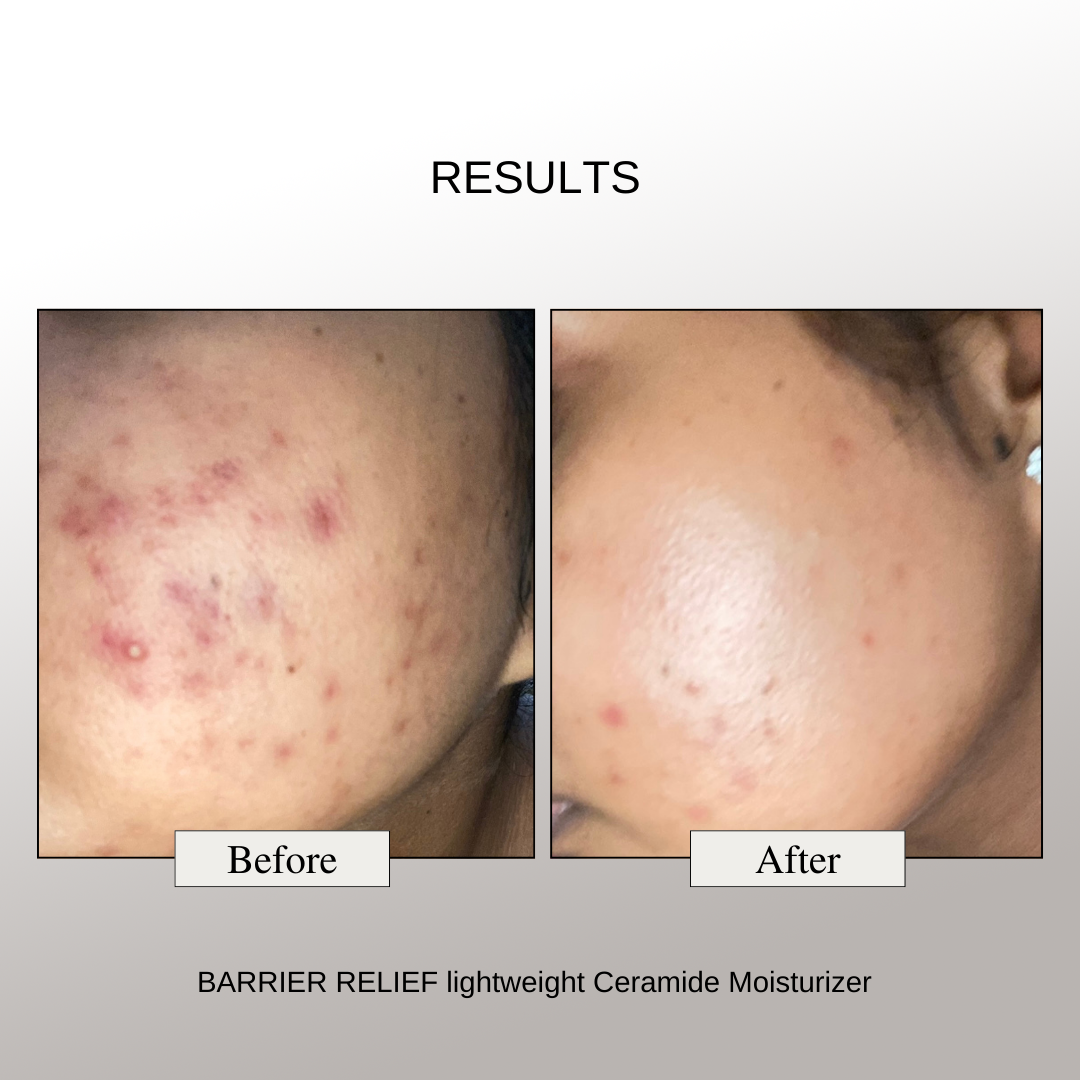 The Formularx Barrier Relief Lightweight Ceramide Moisturizer results