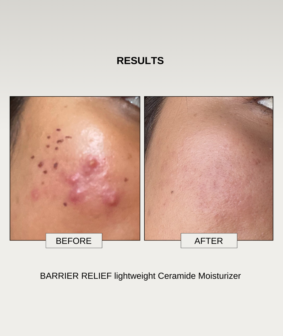 The Formularx Barrier Relief Lightweight Ceramide Moisturizer results
