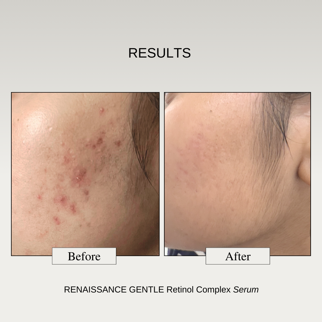 The Formularx Gentle Retinol Complex Serum - Renaissance results