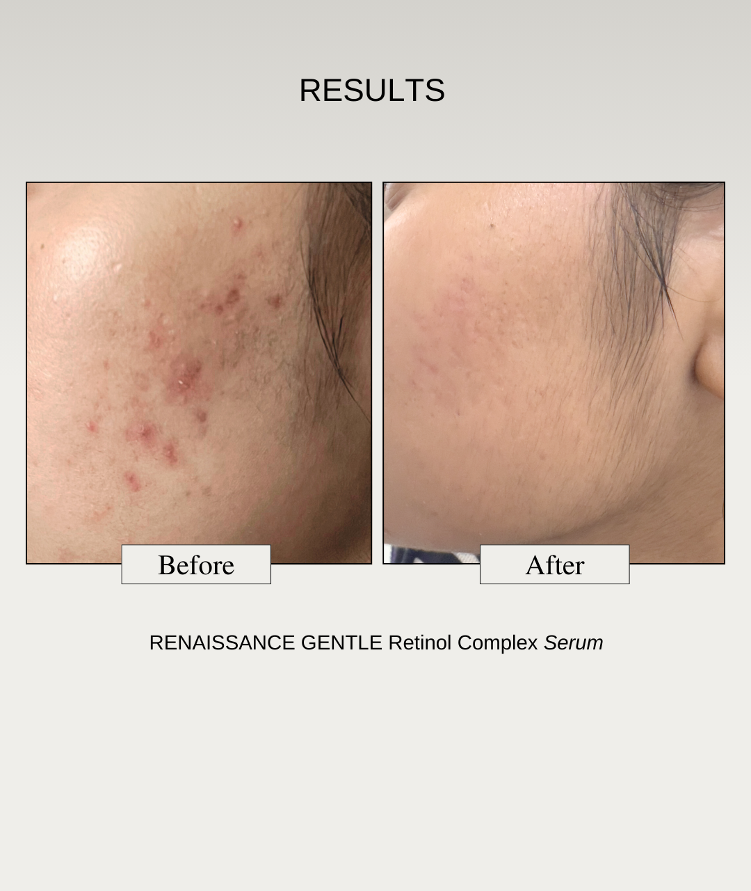 The Formularx Gentle Retinol Complex Serum Results