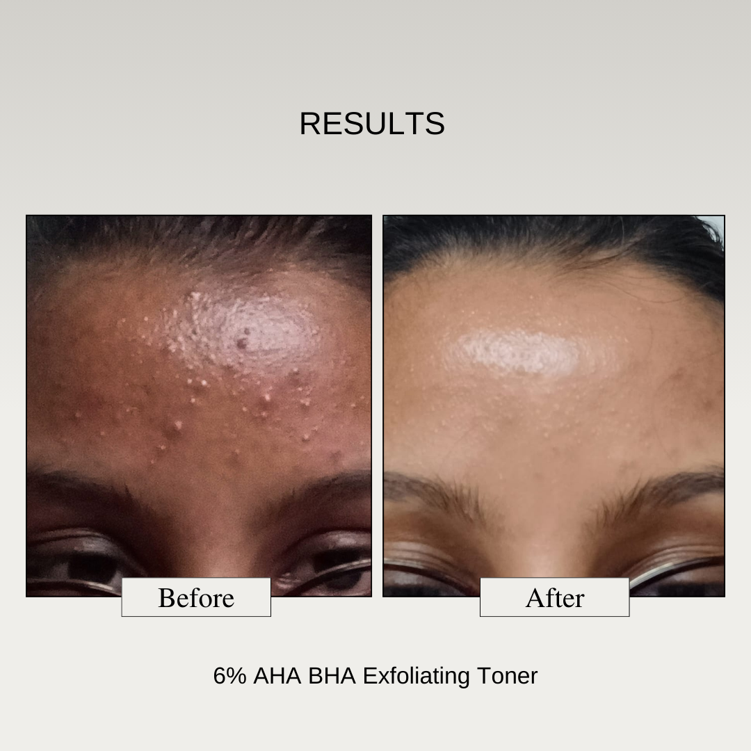 The Formularx Glycolic acid Salicylic acid AHA BHA Exfoliator results