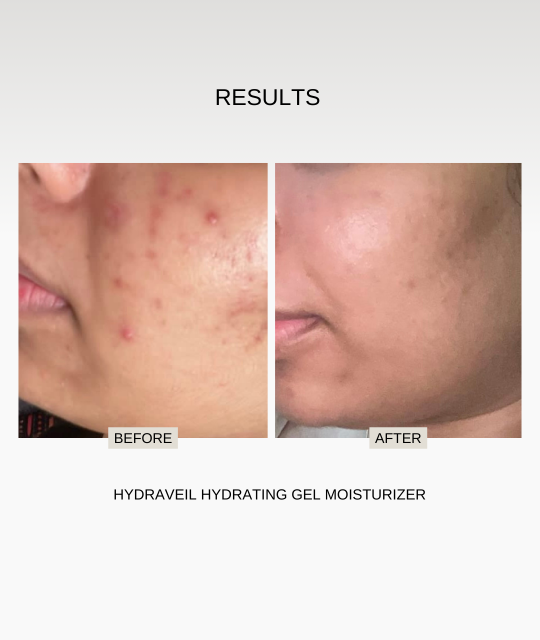 The Formularx Hydra veil acne & fungal acne safe oil free barrier care moisturizer results